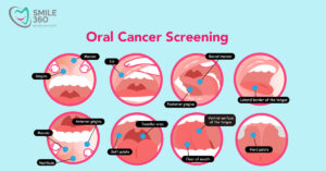 Oral Screening 