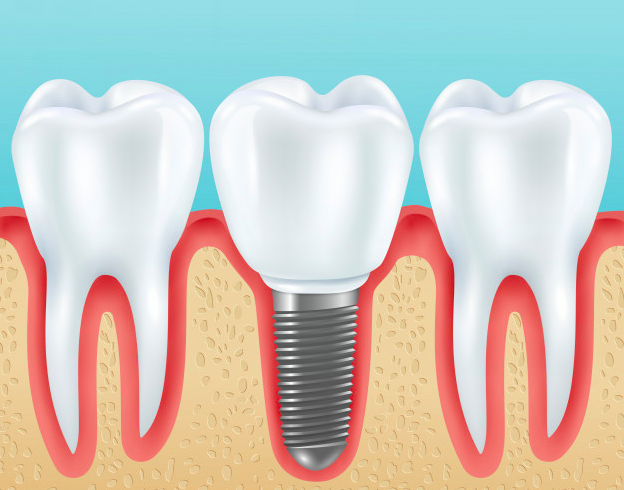 Dental Implants- Smile360 Dental Clinic