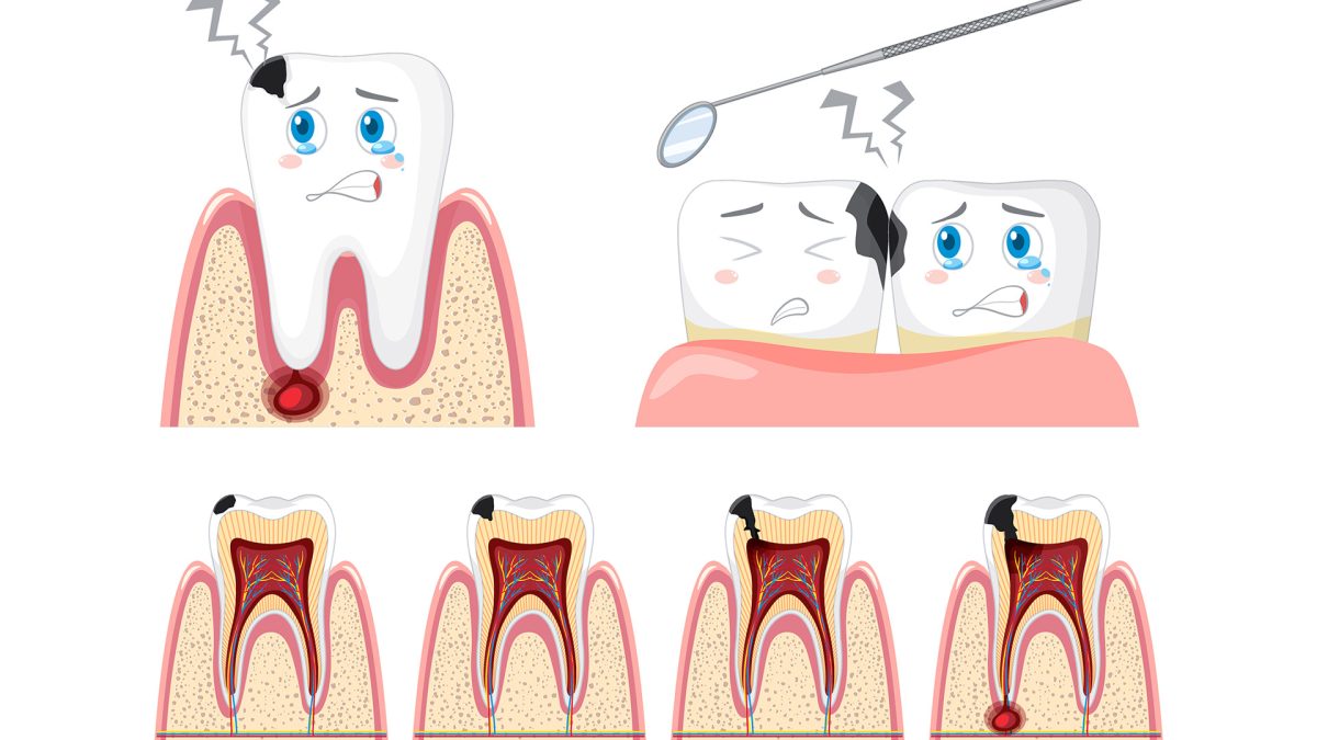 Understanding the Types of Dental Caries | Smile 360 Dental Clinic