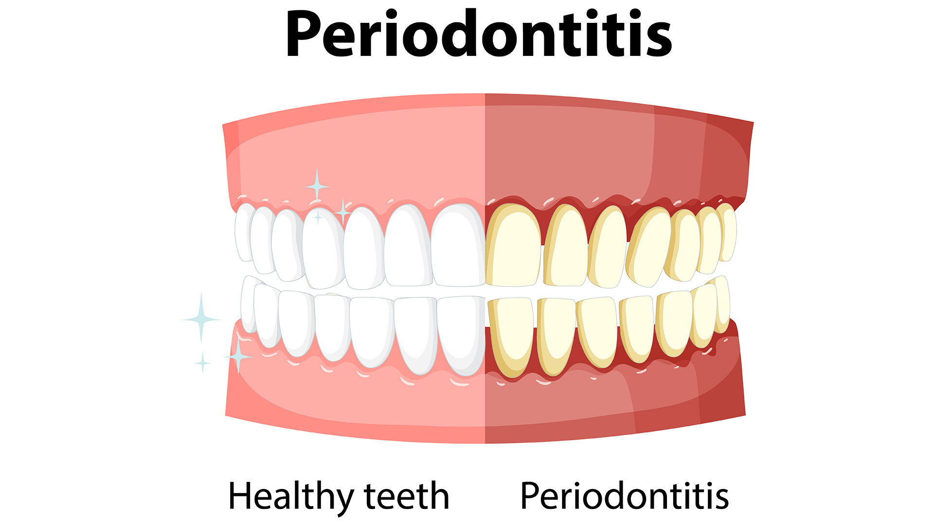 Pericoronitis treatment at home: Taming the Wisdom Toothache