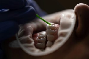 The Hidden Dangers of Dental Cavities